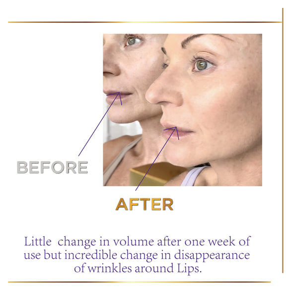 TRIXSENT Volume Lip Therapy Set - Trixsent Beauty Care 